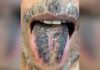 После перенесенного инсульта язык мужчины из Индии стал черным и мохнатым