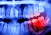 Японские ученые установили связь между здоровьем полости рта и мозга