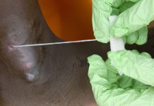 Человечество в шаге от полной победы над второй (после оспы) инфекционной болезнью в истории