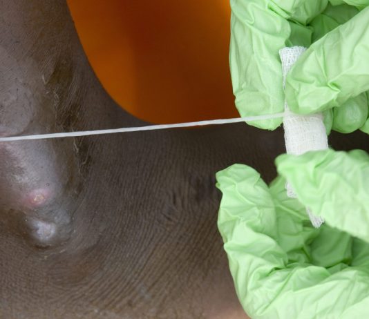 Человечество в шаге от полной победы над второй (после оспы) инфекционной болезнью в истории